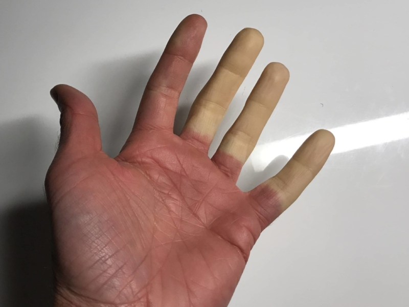 Syndrome de Raynaud avec doigts blancs